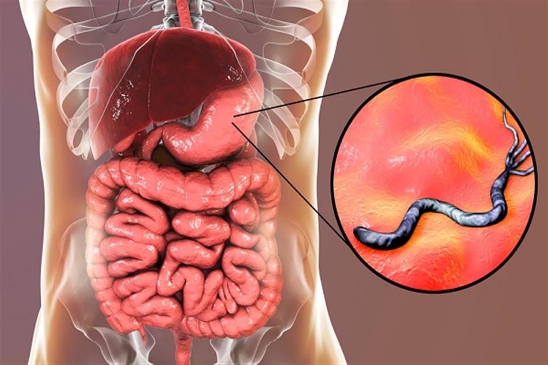 ما هي أعراض جرثومة المعدة وما هي طريقة علاجها والتخلص منها
