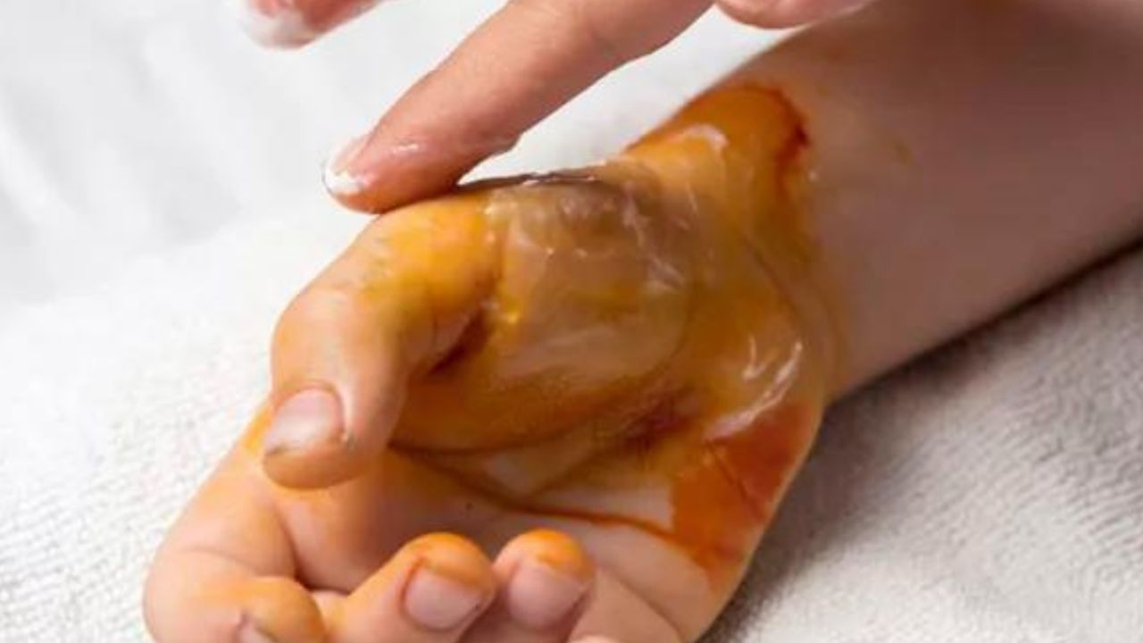 وصفات طبيعية لعلاج آثار الحروق
