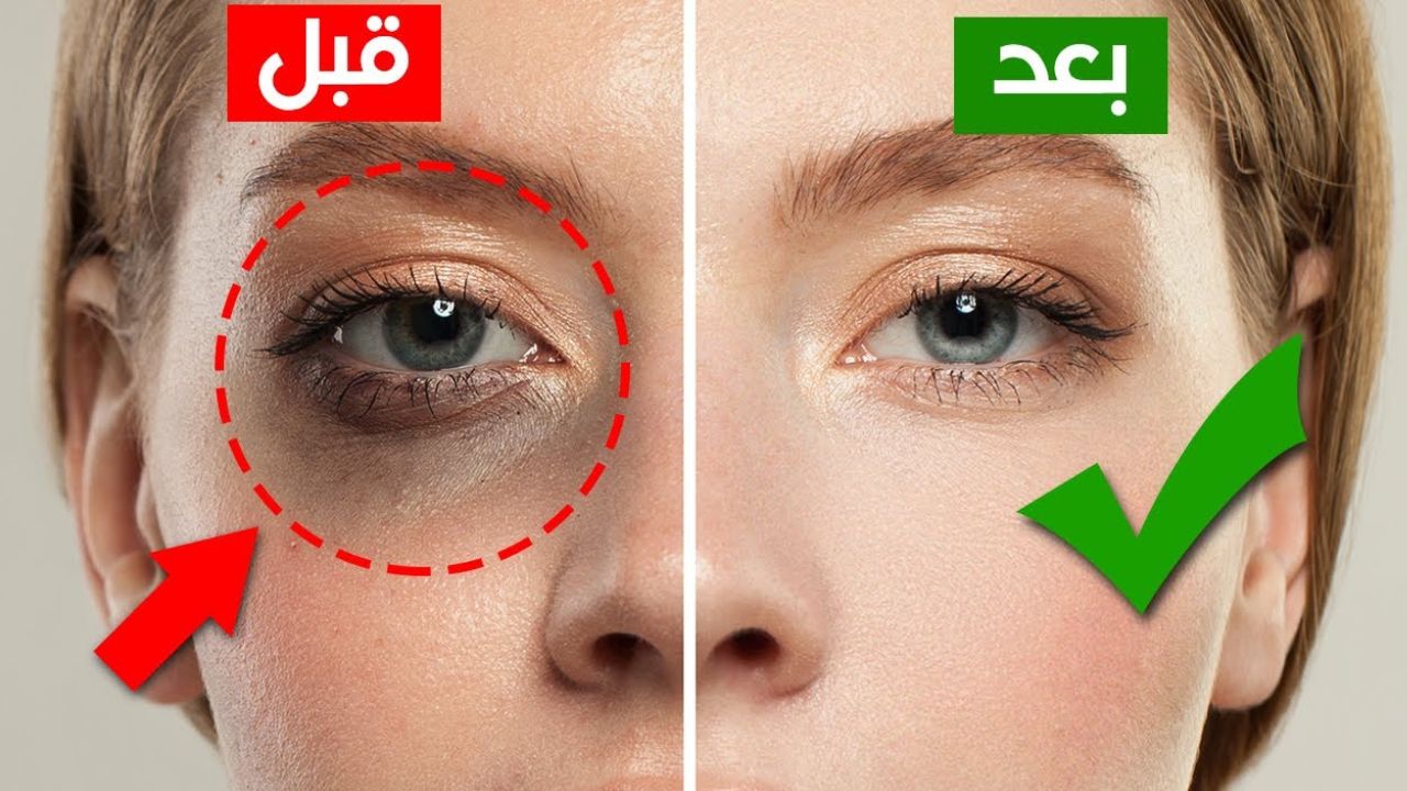 وصفه سحرية للتخلص من الهالات السوداء تحت العين