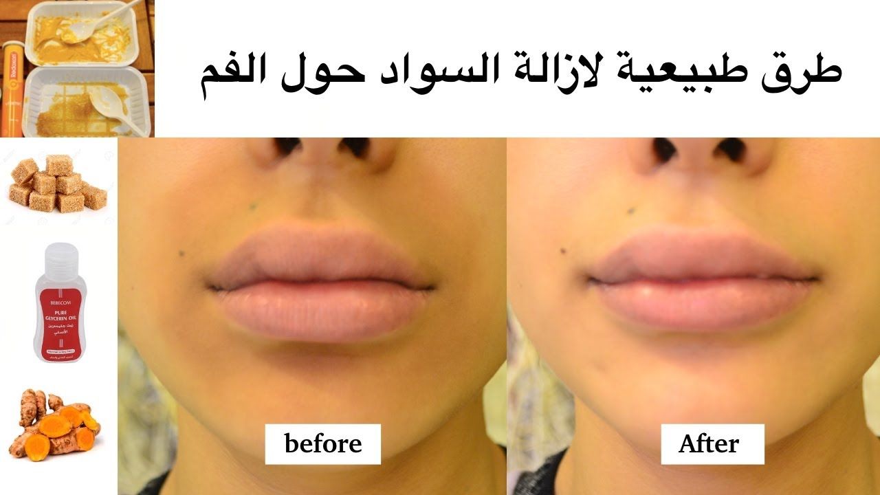 الاسمرار حول الفم