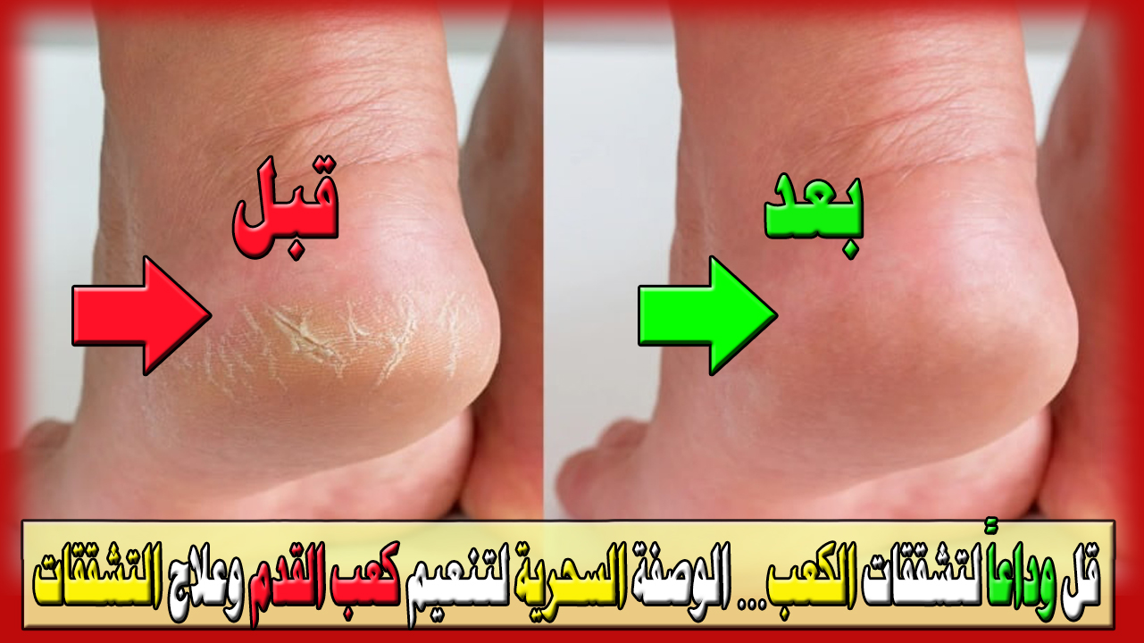 الوصفة السحرية لتنعيم كعب القدم وعلاج التشققات