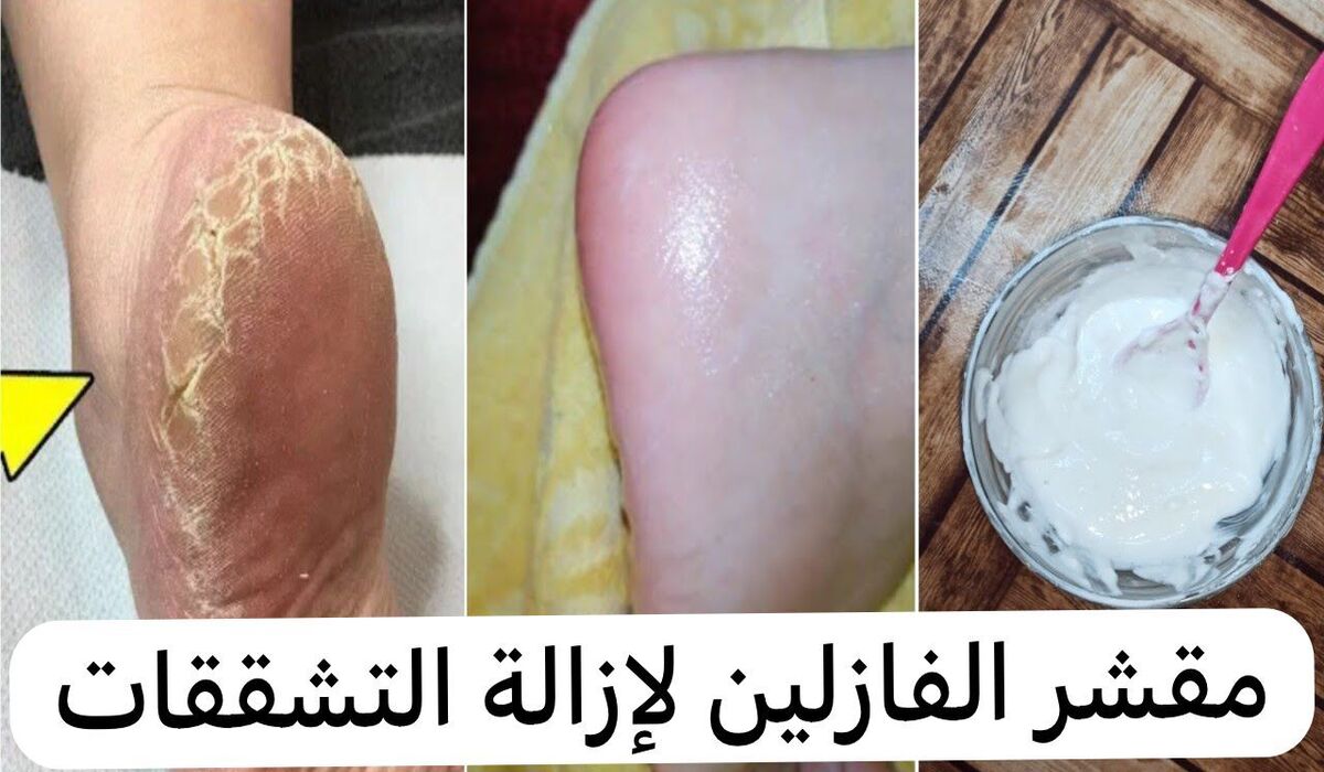 إزالة الجلد الميت والقشور من القدمين