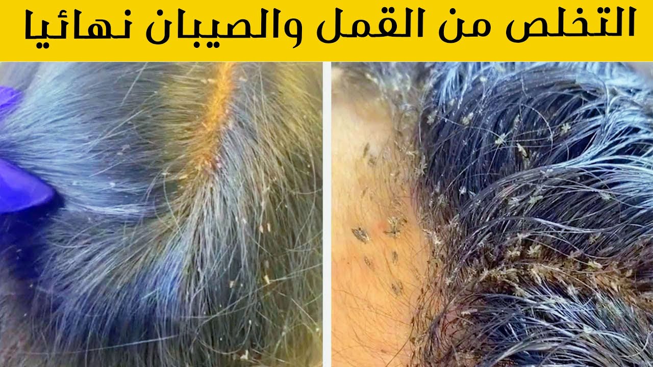 طريقة التخلص من قمل الرأس والصبان نهائياً من الشعر بمكون لا يخطر على بالك نهائيا