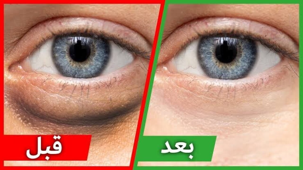 كمادات الشاي البارد