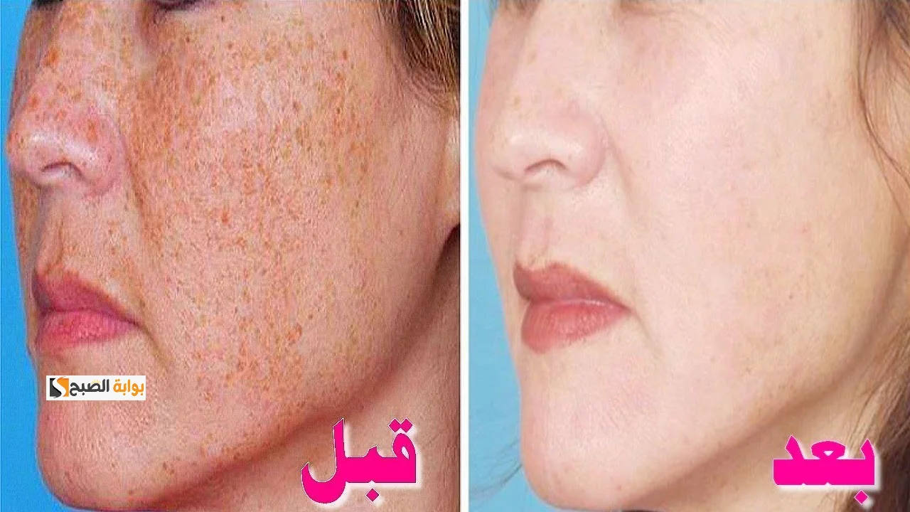 إزالة الحبوب من الوجه