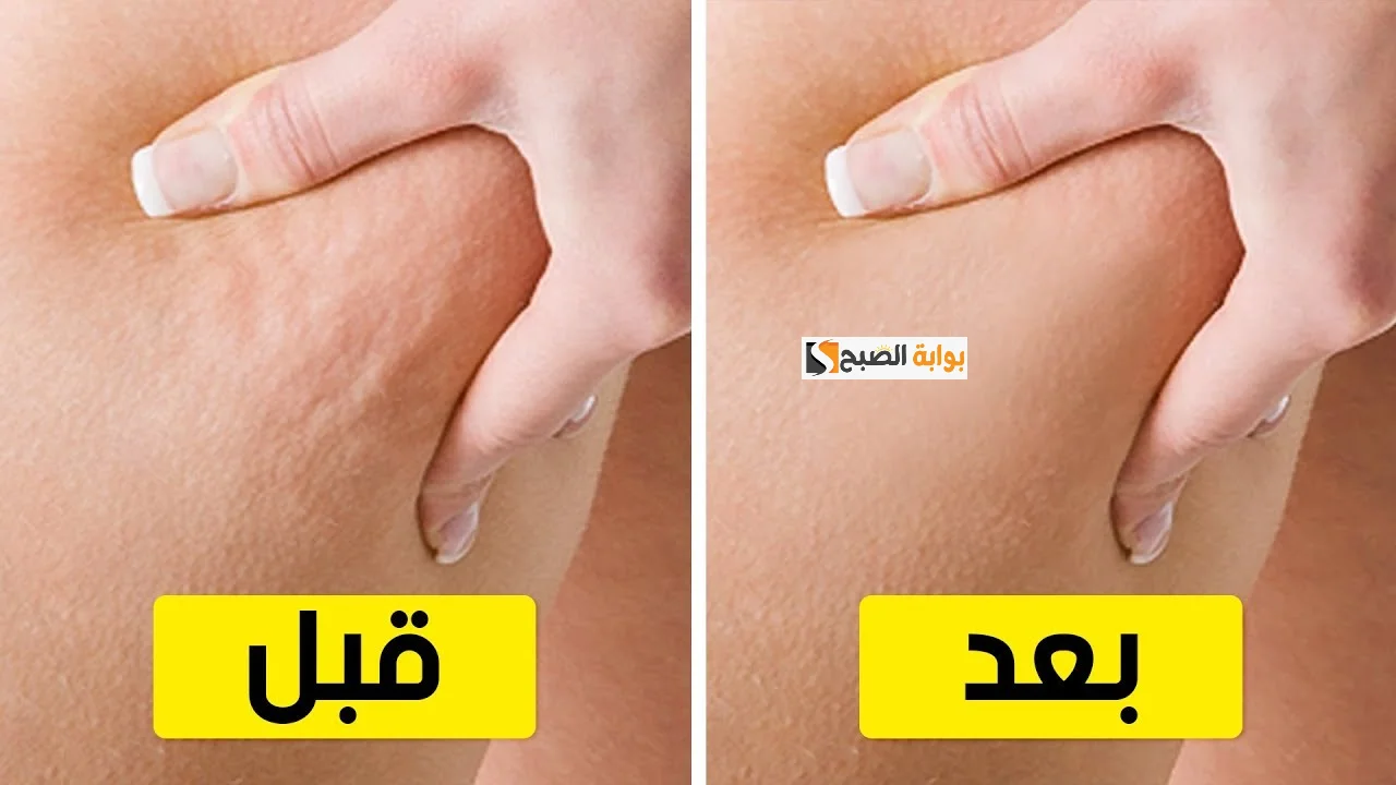 إزالة السيلوليت
