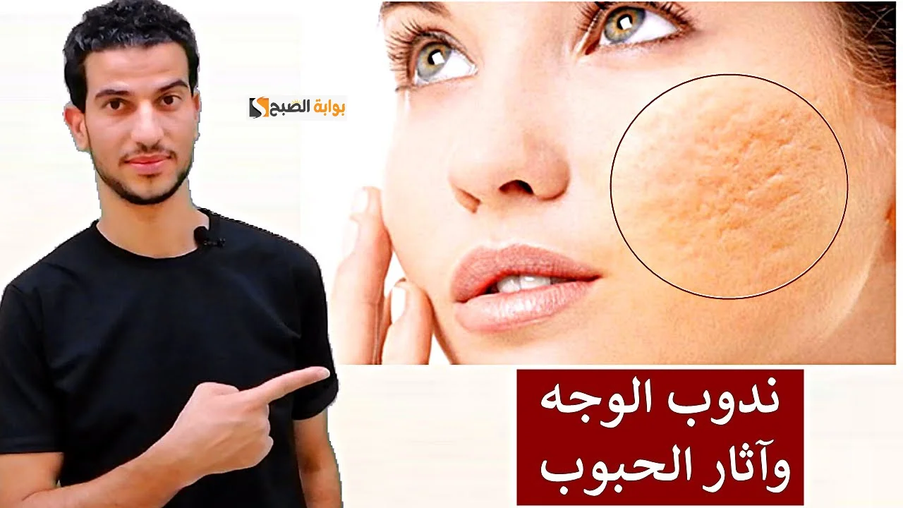 إزالة حب الشباب