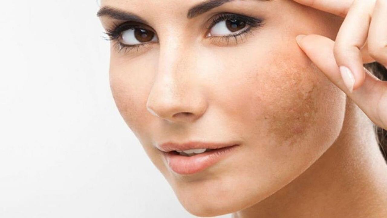 التخلص من البقع الداكنة والتصبغات
