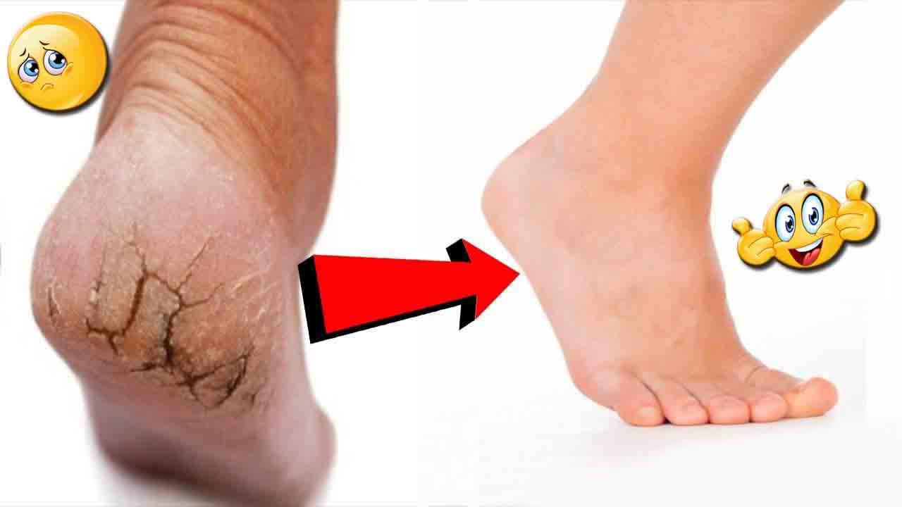 التخلص من تشققات القدمين 1