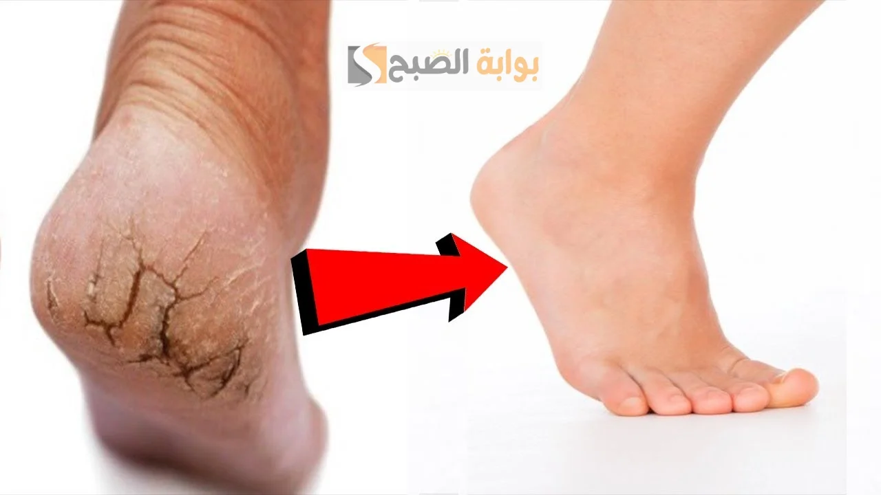 تشققات القدمين