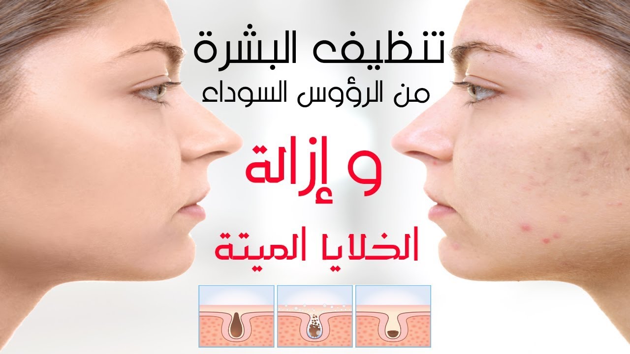 تقشير البشرة