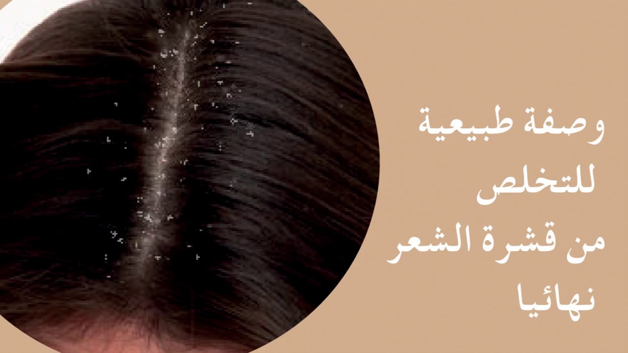 طرق طبيعية للتخلص من القشرة