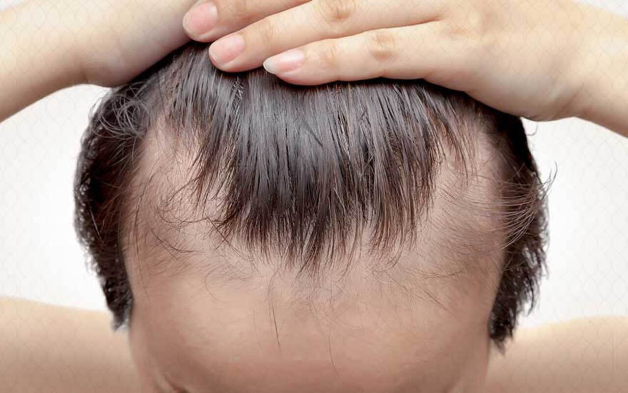 طرق علاج ضعف الشعر طبيعيًا