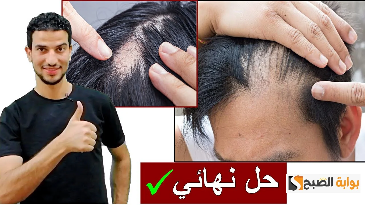 علاج فراغات الشعر