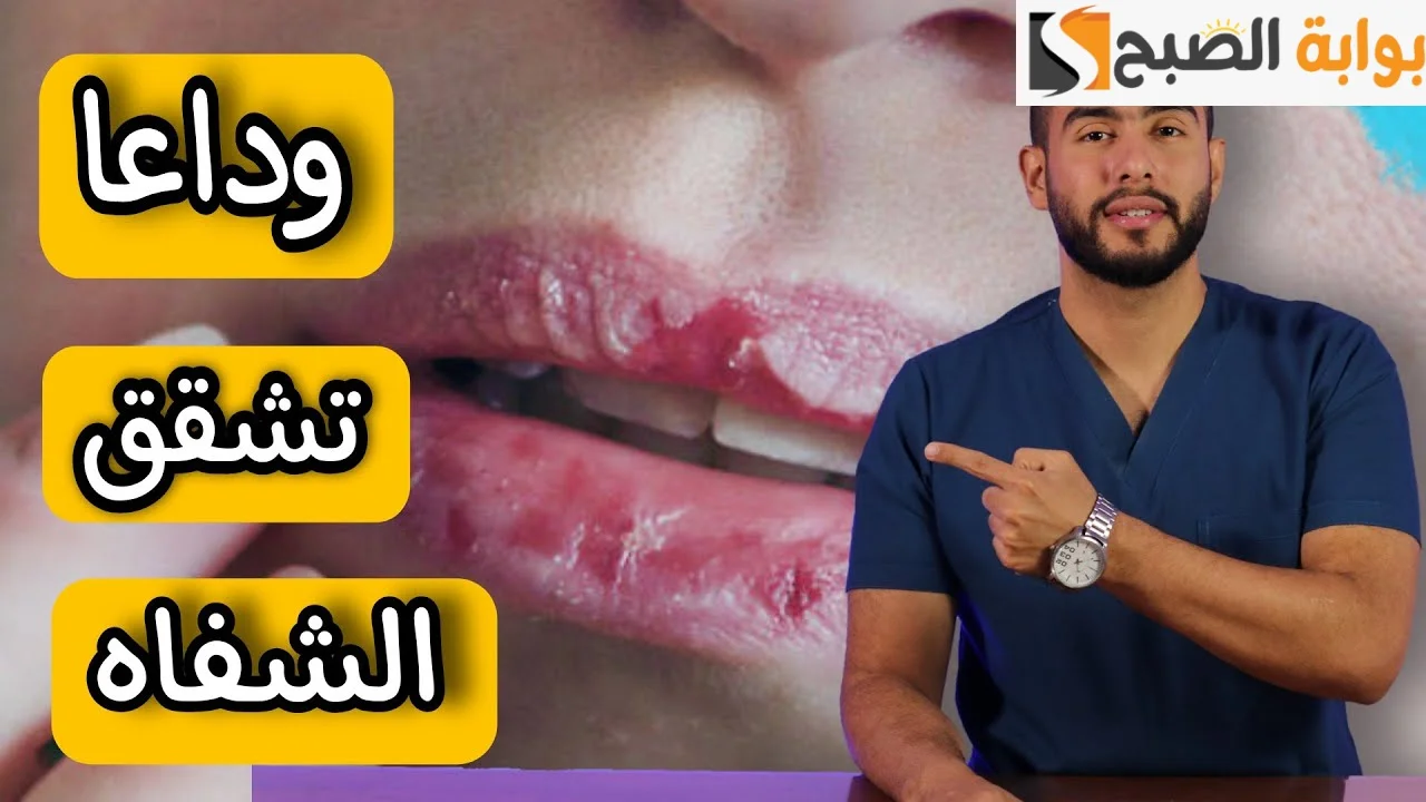 تشقق الشفايف