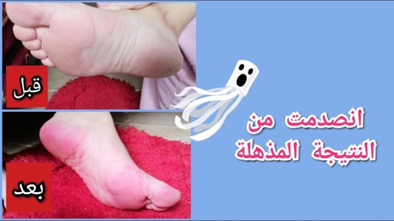 خلطة القهوة لتقشير القدمين