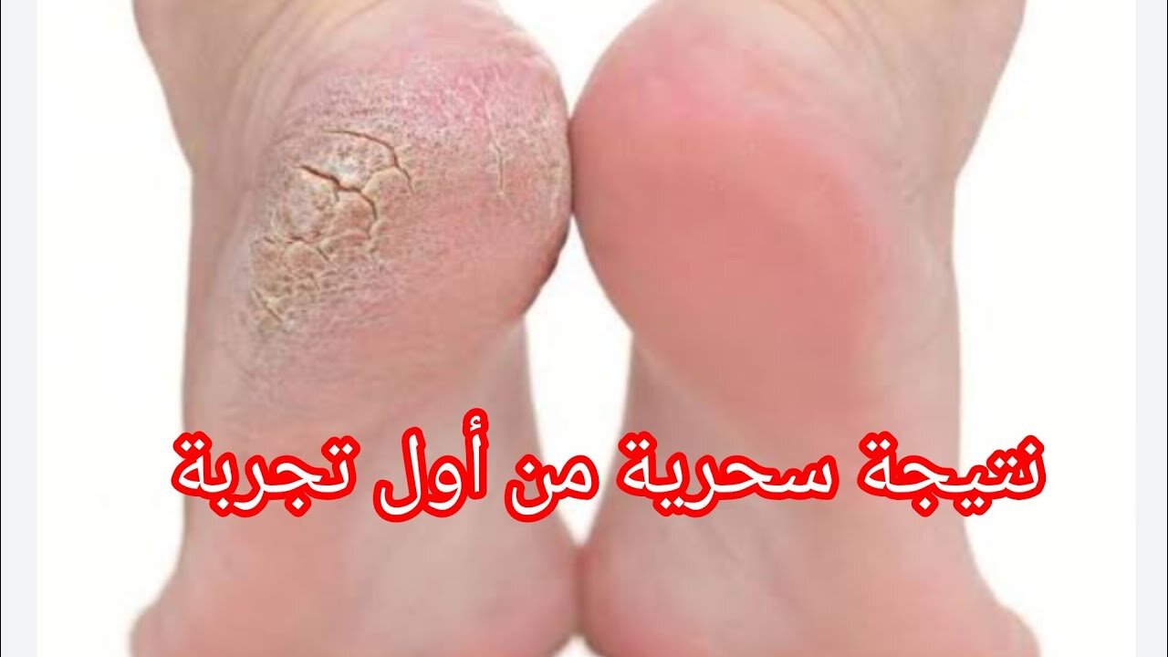 مقشر زيت الزيتون والسكر للقدمين