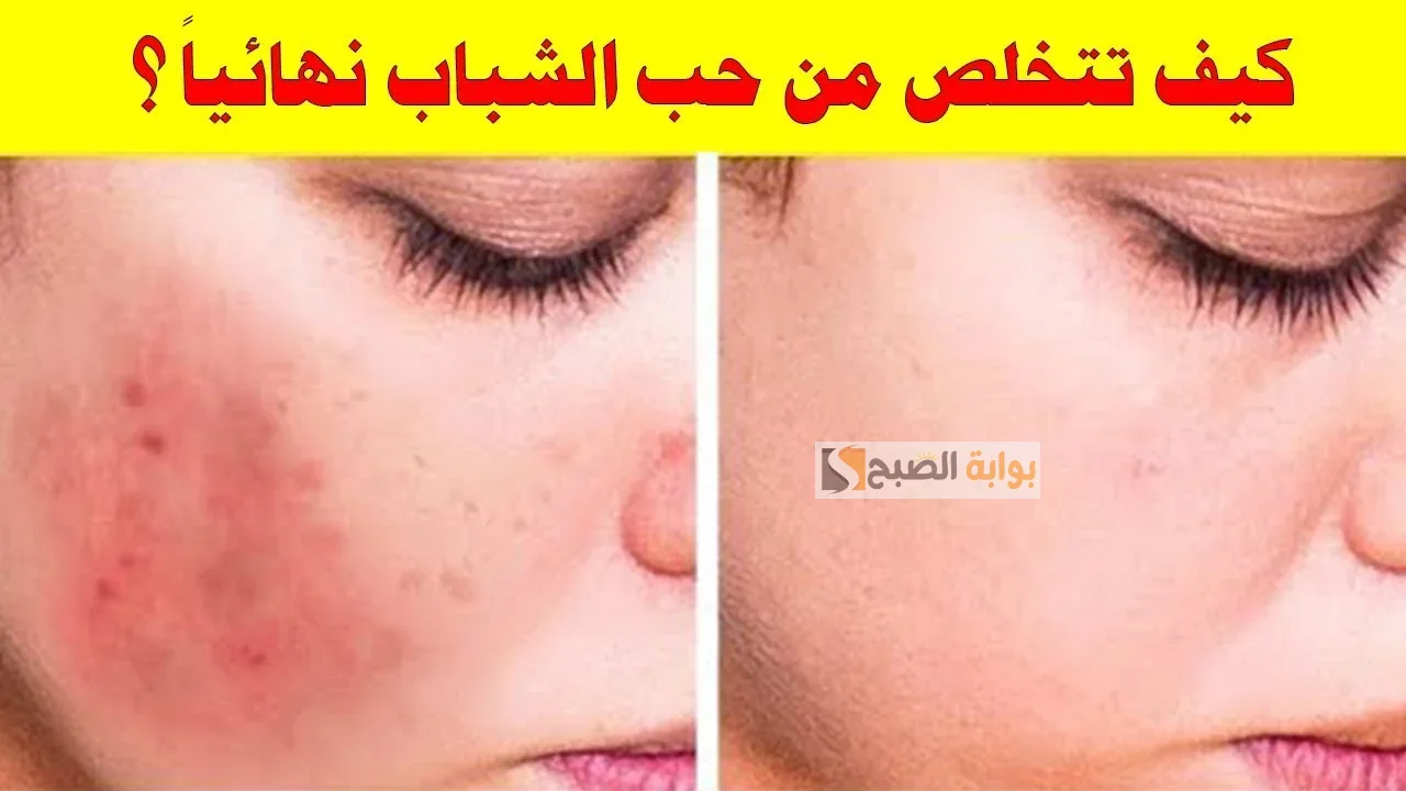التخلص من حب الشباب