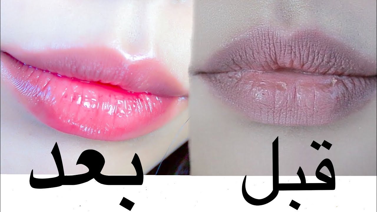 تشقق الشفايف