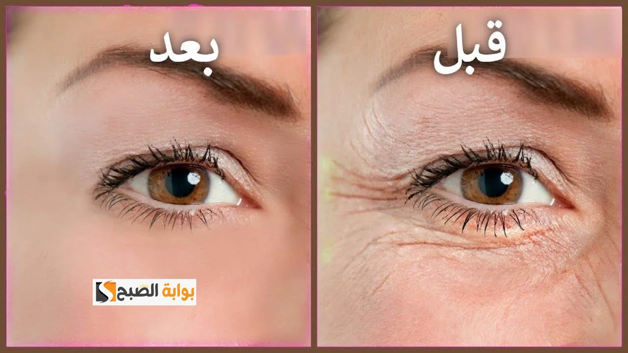 علاج تجاعيد العين