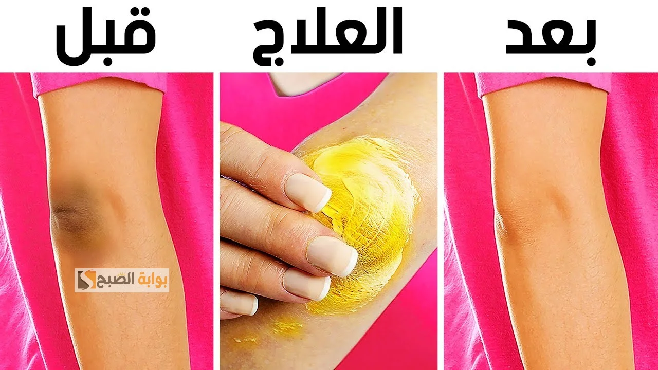 علاج سواد الركب والأكواع