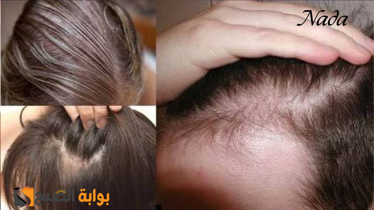 علاج تساقط الشعر في المنزل