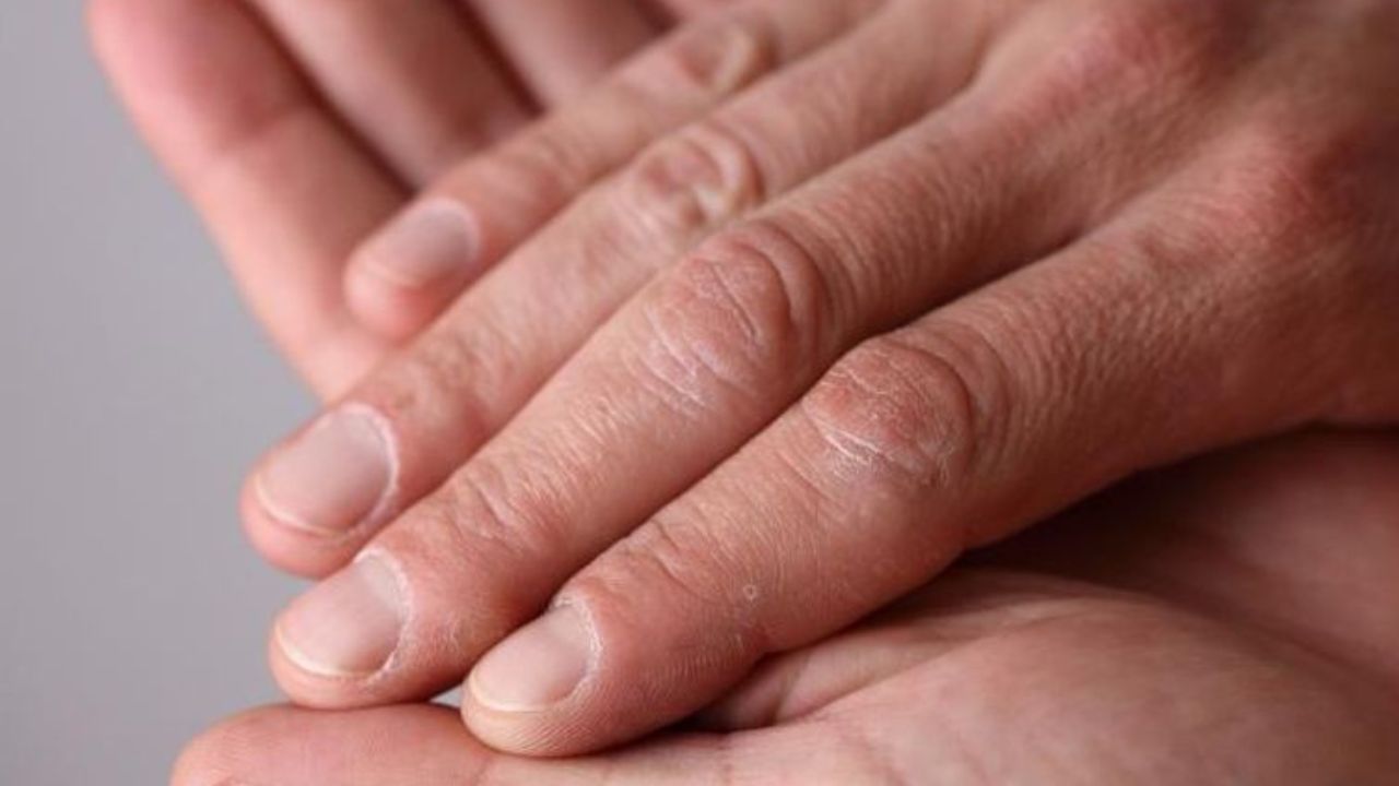 وصفات طبيعية لعلاج جفاف اليدين والتشققات