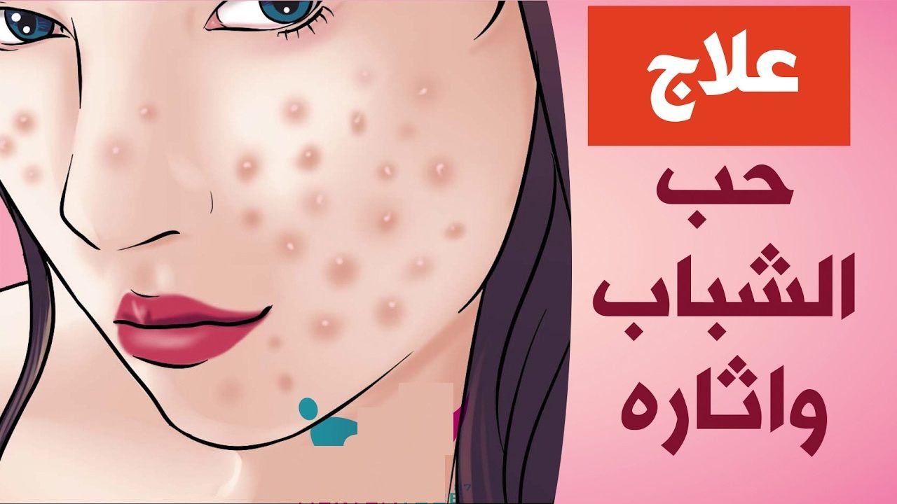 وصفات طبيعية للتخلص من آثار حب الشباب