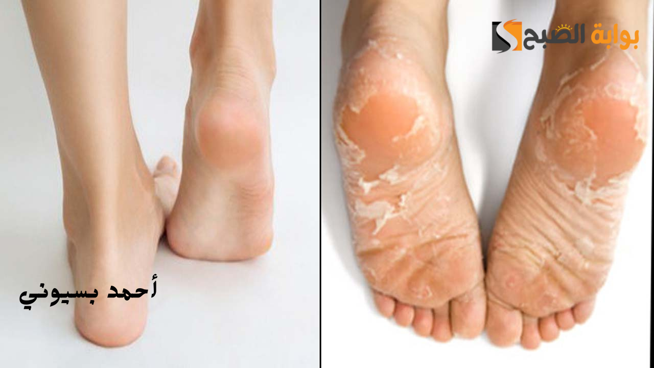 وصفات طبيعيه لتنظيف وتبييض كعوب الرجلين