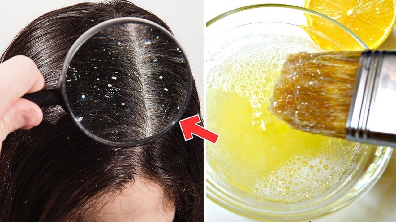 الليمون وزيت الزيتون لعلاج قشرة الشعر
