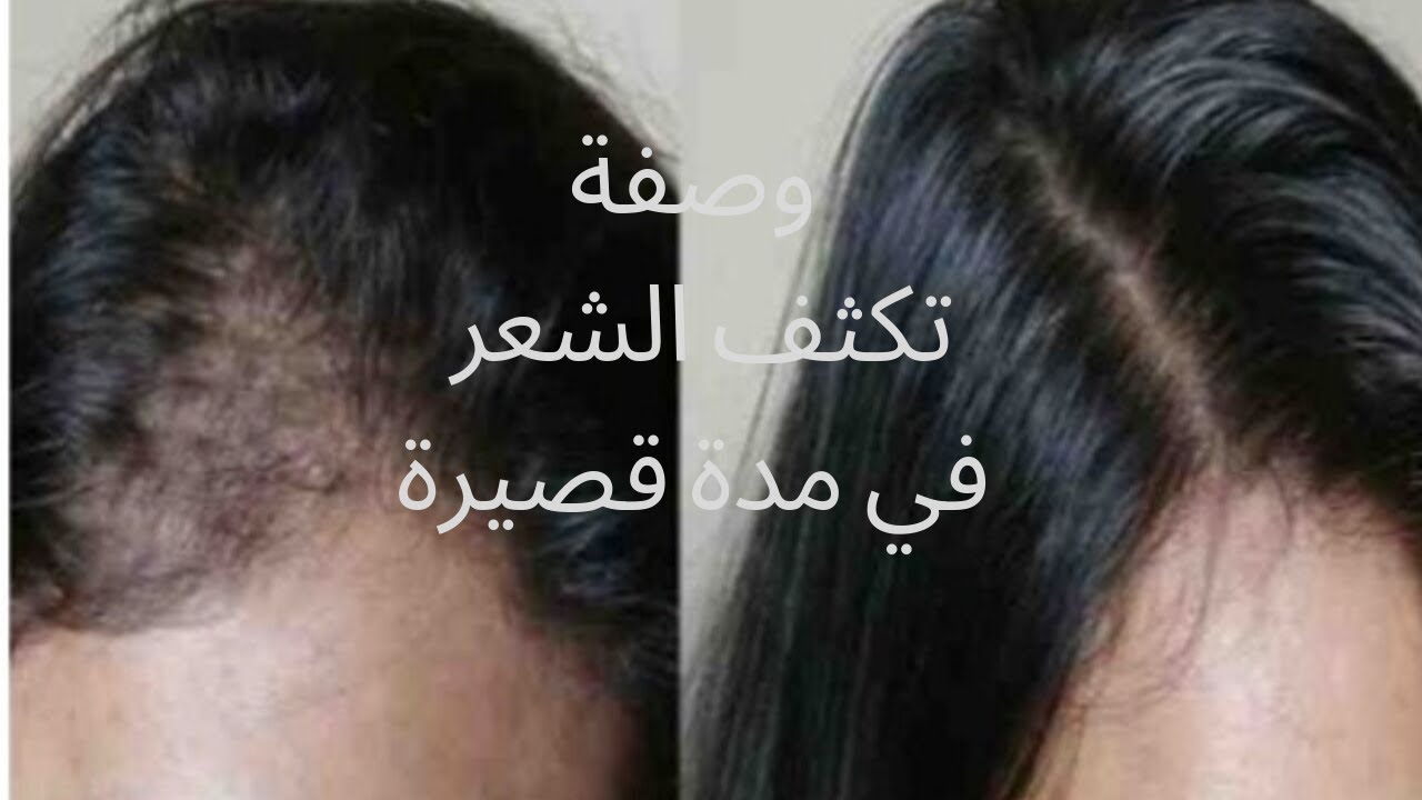 وصفة لمنع تساقط الشعر وتكثيفه