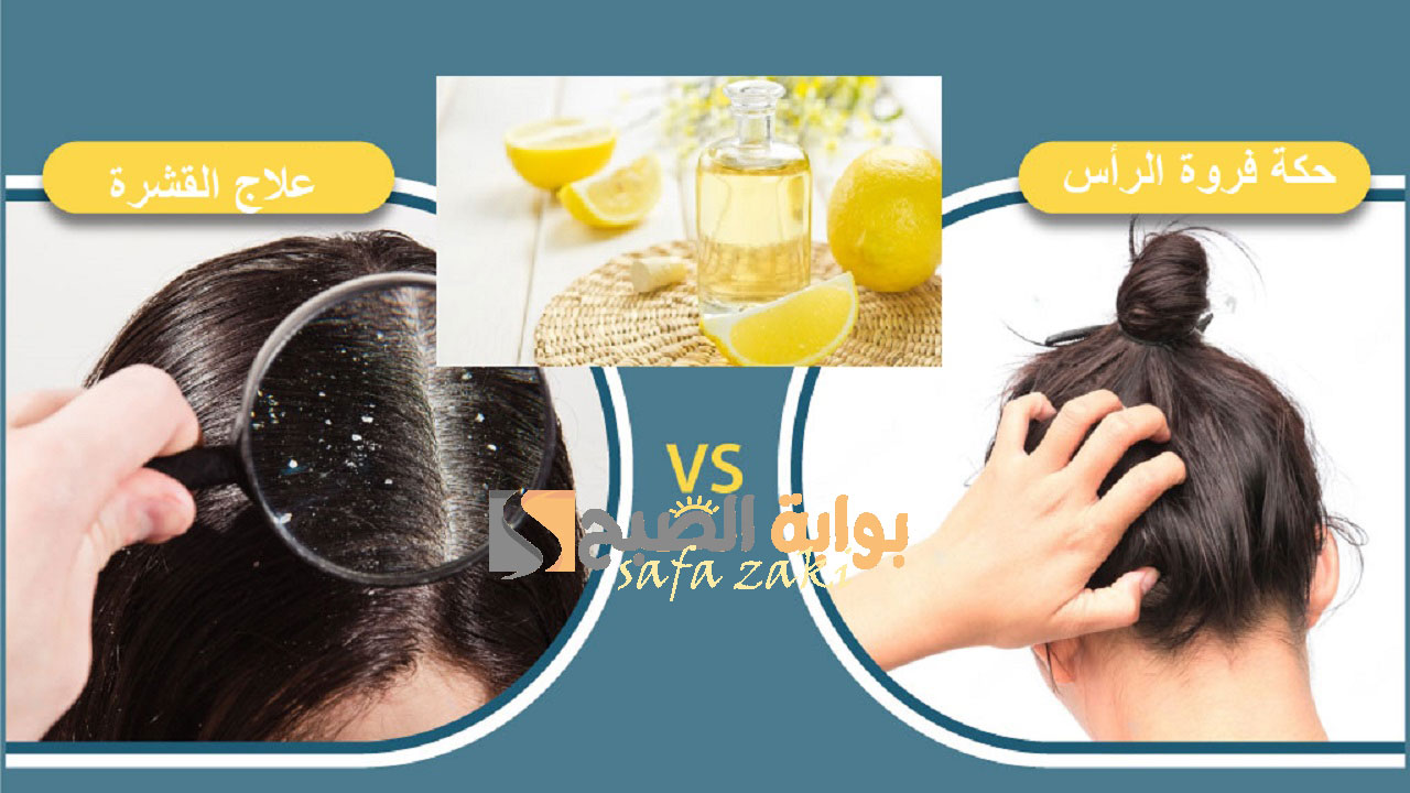 Treat Dandruff And itchy