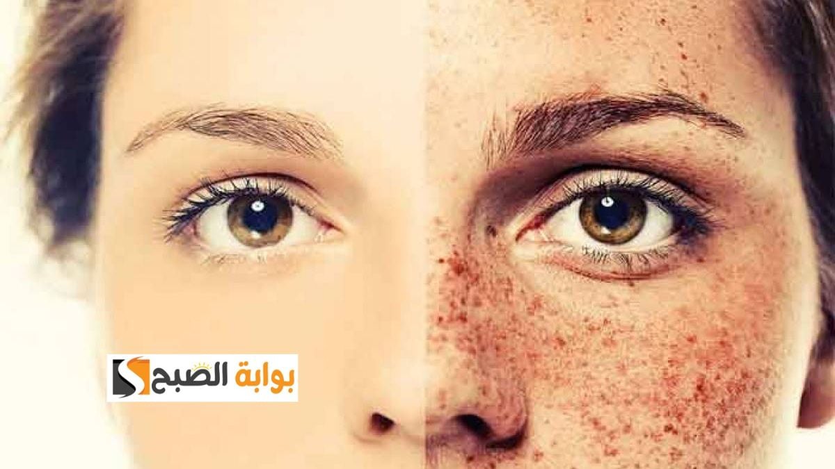 قناع الكركم والزبادي لعلاج النمش