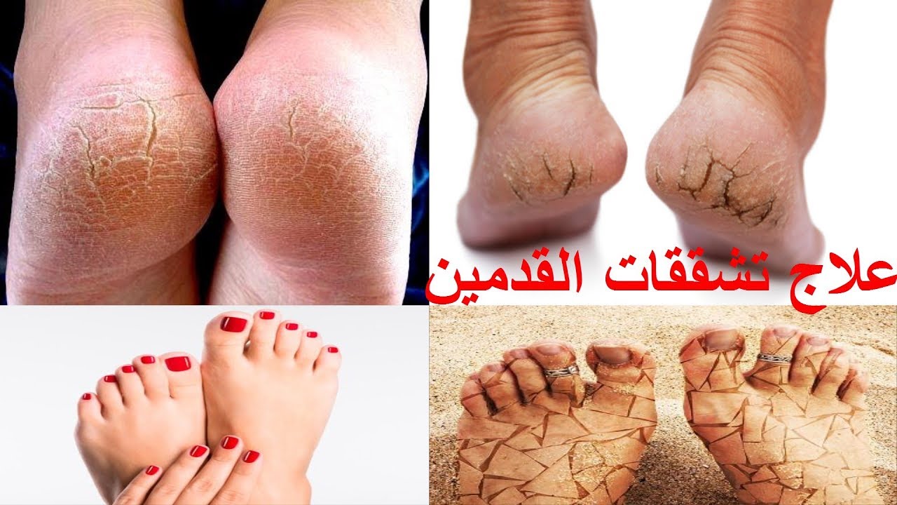 وصفة الشمع والعسل للتخلص من تشققات القدمين