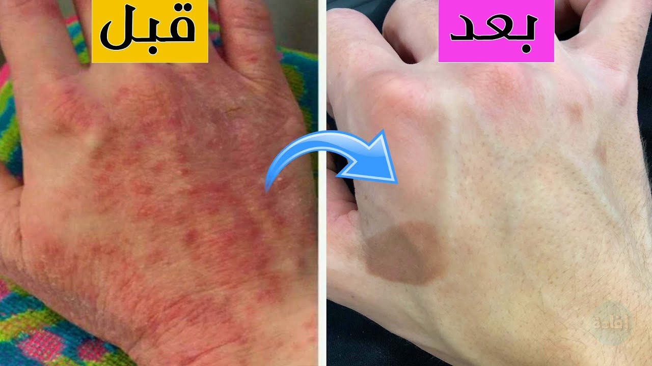 وصفة للتخلص من جفاف اليدين والرجلين في الشتاء