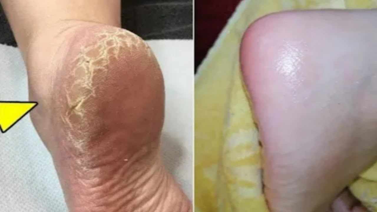 طريقة عمل وصفات علاج تشققات القدمين الطبيعية هتخلي كعب رجلك ناعم مثل الأطفال