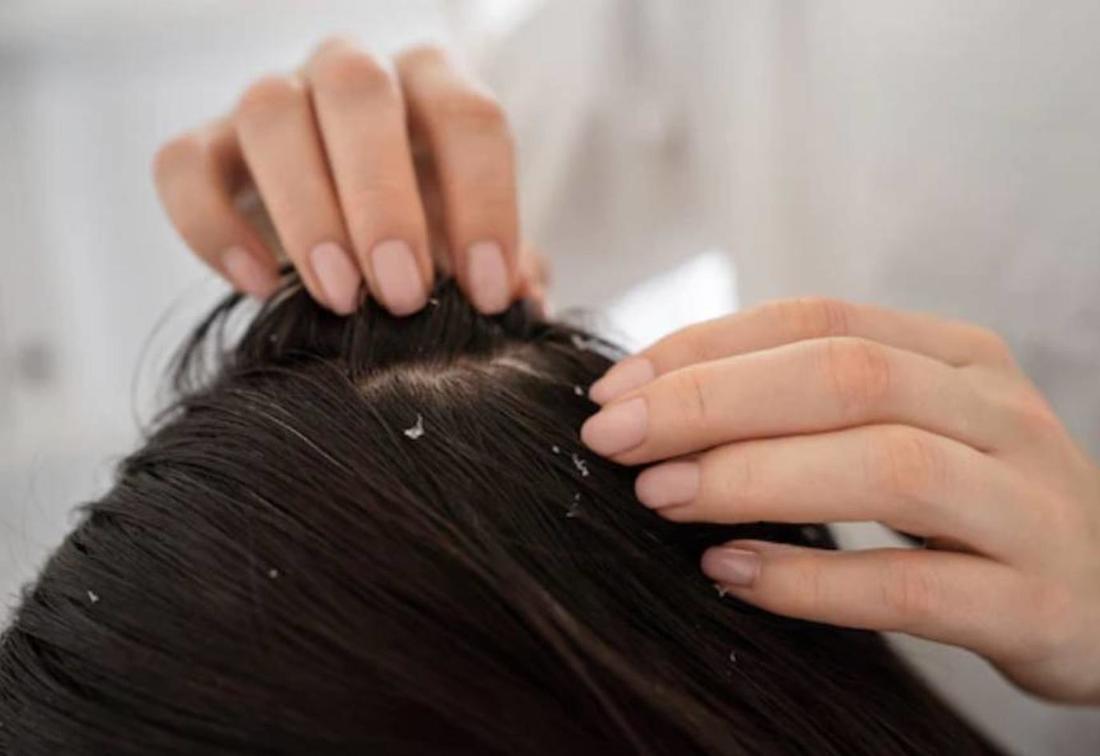 من أجل فروة صحية خالية من القشرة.. وصفة الخردل لشعر أكثر نعومة