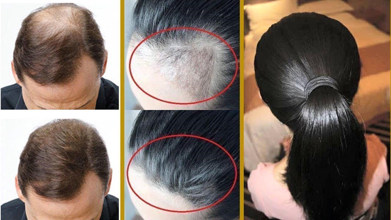 وصفة طبيعية لملء فراغات الرأس وإنباته بشكل طبيعي